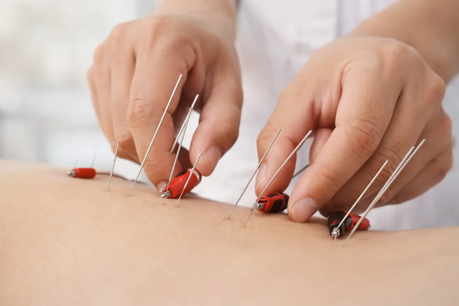 Electroacupuntura: estimulación eléctrica en agujas de acupuntura